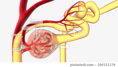 Glomerulonephritis is a group of renal conditions characterized by inflammation of the glomeruli within the kidney. 104131174