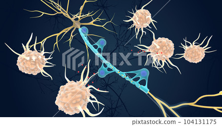 Autoimmune Attack on Myelin Sheath 104131175