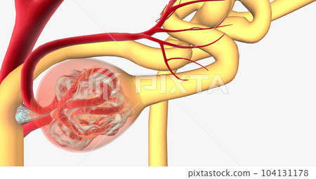 Glomerulonephritis is a group of renal conditions characterized by inflammation of the glomeruli within the kidney. 104131178