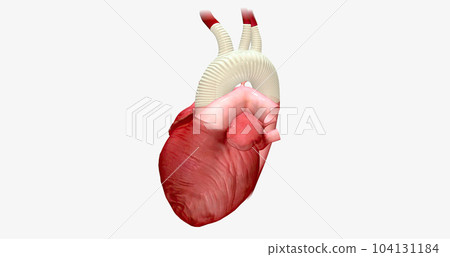 The enlarged portion of the aortic arch is replaced with a synthetic graft. 104131184