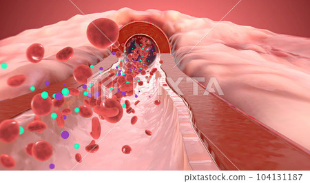 Due to increase of sodium and aldosterone in the blood artery constrict 104131187