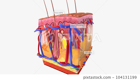 Angioedema is a swelling of the dermis and subcutaneous tissue. Angioedema is a swelling of the dermis and subcutaneous tissue. 104131199