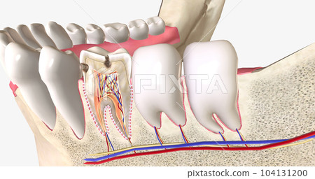 Dental caries, or cavities, are areas of tooth decay caused by acid-producing bacteria in the mouth. Dental caries, or cavities, are areas of tooth decay caused by acid-producing bacteria in the mouth. 104131200