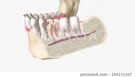 Dental caries, or cavities, are areas of tooth decay caused by acid-producing bacteria in the mouth. 104131207