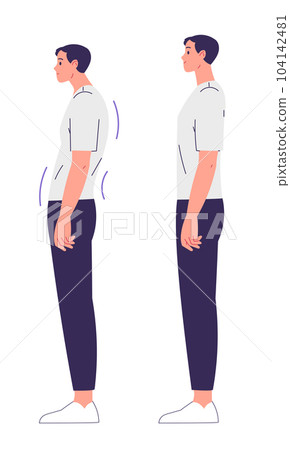 Man with impaired posture and correct posture. Spinal curvature, scoliosis 104142481