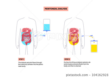 Peritoneal dialysis concept Peritoneal dialysis concept 104162928