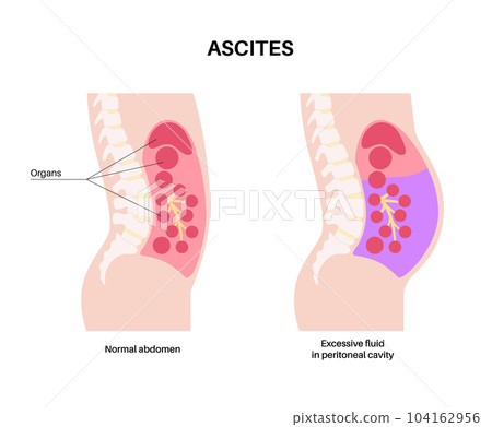Ascites disease poster Ascites disease poster 104162956
