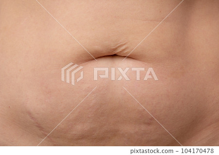 Post-pregnancy belly button altered due to an umbilical hernia or stretched skin overhanging belly button on cropped body Post-pregnancy belly button altered due to an umbilical hernia or stretched skin overhanging belly button on cropped body 104170478