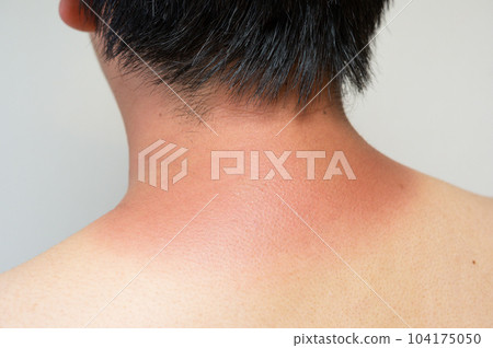 Man with painful sunburn 104175050