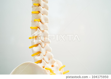 Lumbar spine displaced herniated disc fragment, spinal nerve and bone. Model for treatment medical in the orthopedic department. Lumbar spine displaced herniated disc fragment, spinal nerve and bone. Model for treatment medical in the orthopedic department. 104175950