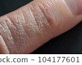Hand dermatitis. Hand eczema closed on black background 104177601