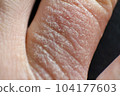 Hand dermatitis. Hand eczema closed on black background 104177603