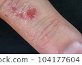 Hand dermatitis. Hand eczema closed on black background 104177604