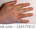 Hand dermatitis. Hand eczema closed on white background 104177612