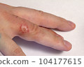 Hand dermatitis. Hand eczema closed on white background 104177615