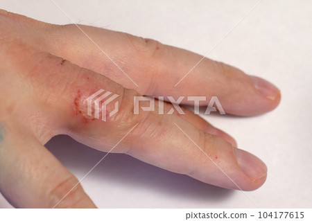 Hand dermatitis. Hand eczema closed on white background 104177615