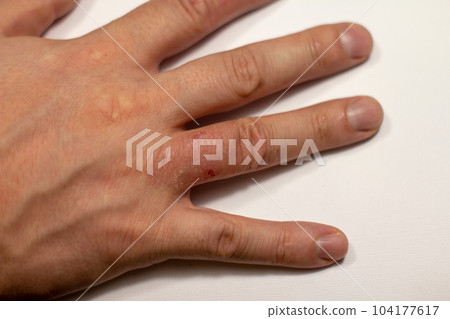 Hand dermatitis. Hand eczema closed on white background 104177617