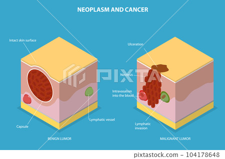 3D Isometric Flat Vector Conceptual Illustration of Neoplasm And Cancer 3D Isometric Flat Vector Conceptual Illustration of Neoplasm And Cancer 104178648