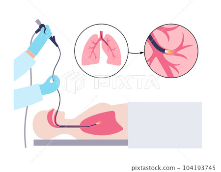 Bronchoscopy procedure concept 104193745