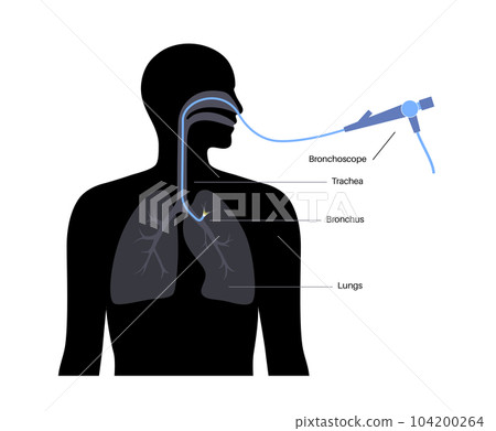 Bronchoscopy procedure concept 104200264