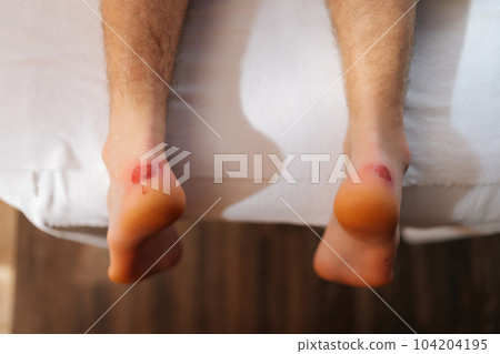 Close-up top view feet with calluses on heels of unrecognizable man lying down on massage table in luxury spa salon. Close up cropped shot of painful wound on mans feet caused by new shoes. Close-up top view feet with calluses on heels of unrecognizable man lying down on massage table in luxury spa salon. Close up cropped shot of painful wound on mans feet caused by new shoes. 104204195