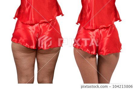 Woman's thighs and buttocks with cellulite. 104213806