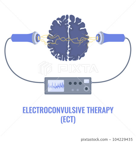 ECT electroconvulsive therapy for severe depression treatment 104229435