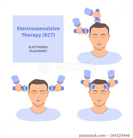 ECT electroconvulsive therapy for severe depression treatment 104229446