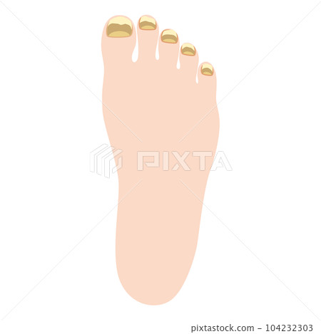Athlete's foot Tinea unguium 104232303