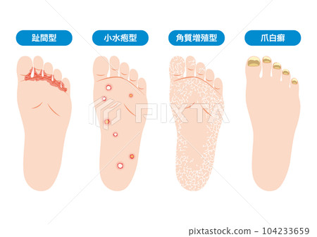 腳氣的類型 104233659