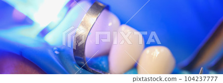 Light falling on teeth during installation of veneers in dental clinic closeup Light falling on teeth during installation of veneers in dental clinic closeup 104237777