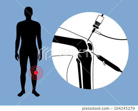 Knee joint arthroscopy Knee joint arthroscopy 104245279