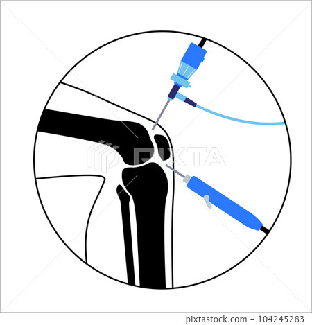 Knee joint arthroscopy Knee joint arthroscopy 104245283