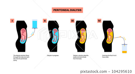 Peritoneal dialysis concept Peritoneal dialysis concept 104295610