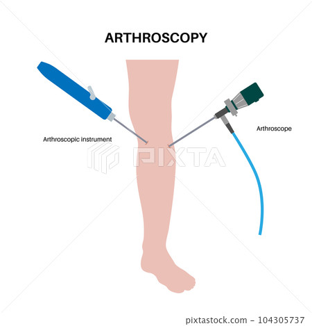 Knee joint arthroscopy Knee joint arthroscopy 104305737