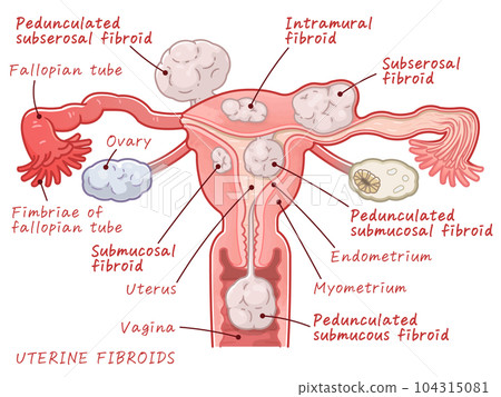 Uterine fibroids,ovary, uterus, illustration, uterus, endometrium 104315081