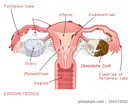 子宮內膜異位症，巧克力囊腫，卵巢，子宮，子宮 104315082