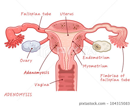 uterus, adenomyosis of uterus, ovary, uterus, illustration 104315083
