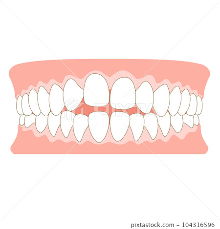 開牙合的牙齒排列 104316596