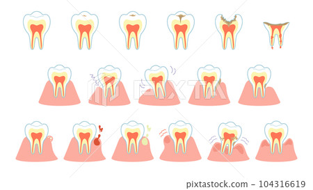 Caries progression and gum symptoms set 104316619