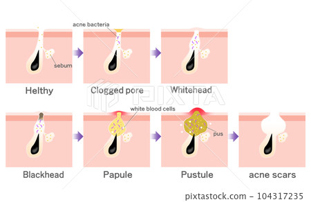 acne, skin, progression 104317235