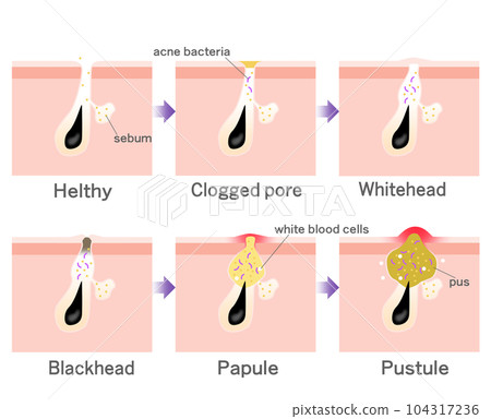 acne, skin, progression 104317236