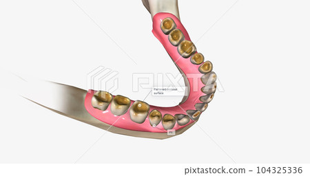 Dental erosion, also known as tooth erosion Dental erosion, also known as tooth erosion 104325336