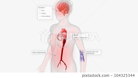 Aortitis is a rare condition characterized by inflammation of the aorta. 104325344