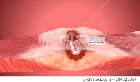 Due to increase of sodium and aldosterone in the blood artery constrict Due to increase of sodium and aldosterone in the blood artery constrict 104325354