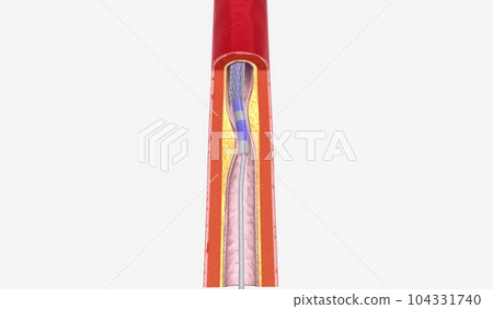 Angioplasty is a minimally invasive procedure that uses a cathet 104331740