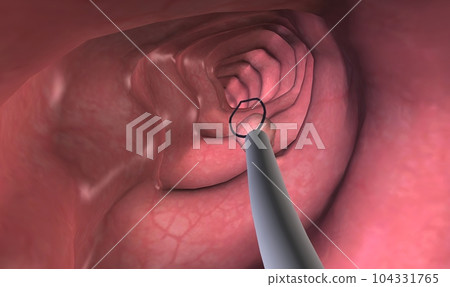 Colonoscopy is a procedure that allows you to see inside your entire large intestine. Colonoscopy is a procedure that allows you to see inside your entire large intestine. 104331765