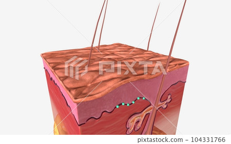 Anal Warts in Skin Tissue Anal Warts in Skin Tissue 104331766