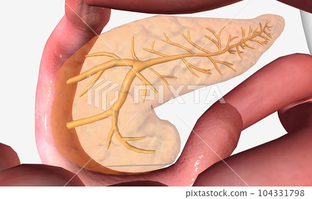 Gastric sleeve surgery is a surgical procedure in which most of the stomach is removed for weight loss 104331798