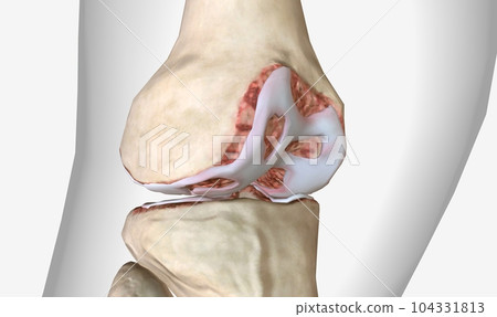 Osteoarthritis is a degenerative form of arthritis that affects articular cartilage Osteoarthritis is a degenerative form of arthritis that affects articular cartilage 104331813